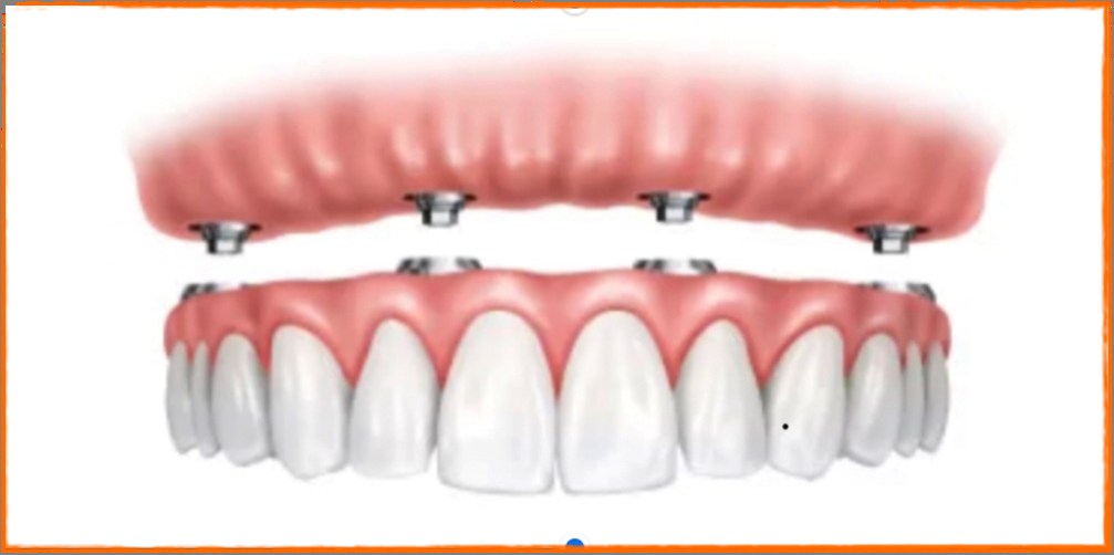 Couronne et Bridge sur implant