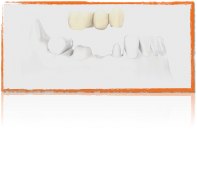 Notre zone d'activité pour ce service Pose de couronnes dentaires