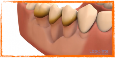 Notre zone d'activité pour ce service Pose de prothèse de dent en stellite
