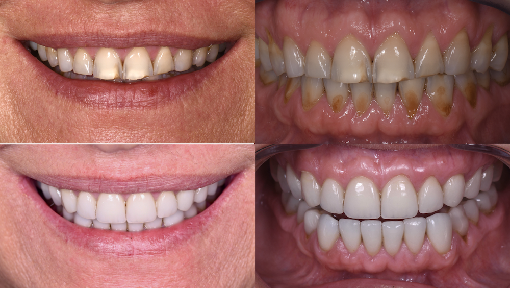 Les Facettes Dentaires sont-elles résistantes ? - Cabinet esthétique  dentaire Maupassant