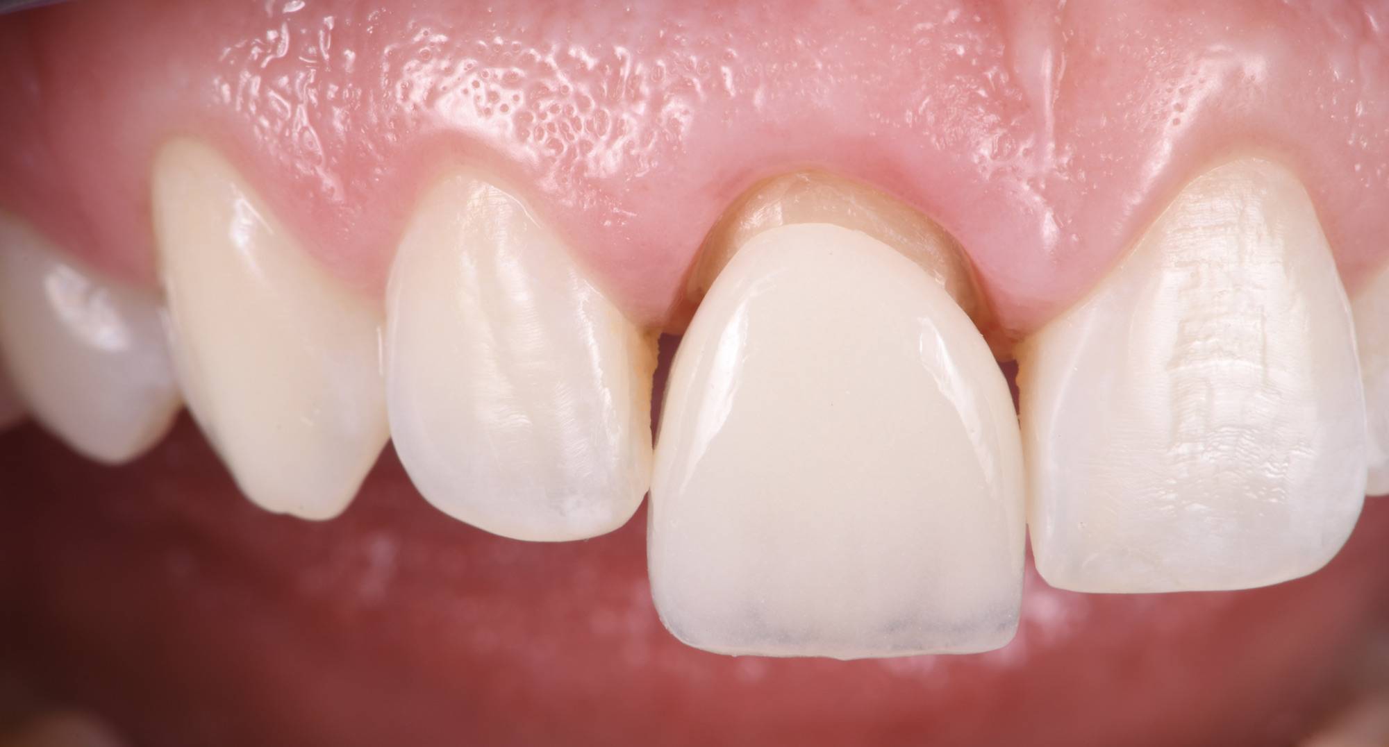 Facettes dentaires céramiques ou composites : Dans quel cas ? Pour qui ?