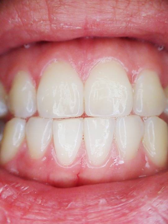 Les Facettes Dentaires par des Spécialistes de la Dentisterie Esthétique à  Marseille dans le 13008 - Cabinet esthétique dentaire Maupassant